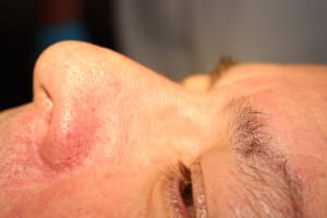 Facial Vein After Left Side