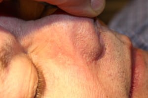 Facial Vein After Right Side