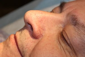 Facial Vein Before Left Side