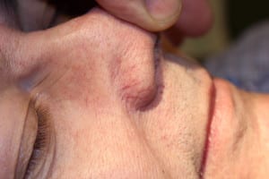 Facial Vein Before Right Side