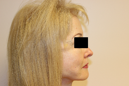 Patient # 63273 Before Photo # 3
