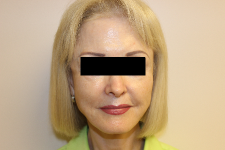 Patient # 63273 After Photo # 2