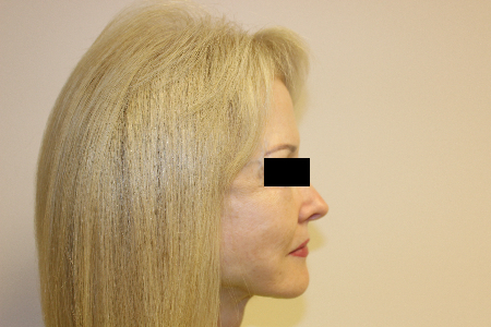 Patient # 63273 After Photo # 4