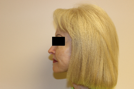 Patient # 63273 After Photo # 6