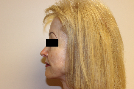 Patient # 63273 Before Photo # 5