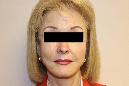 Patient # 63273 Before Photo # 1