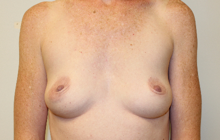 Patient # 46323 Before Photo # 1